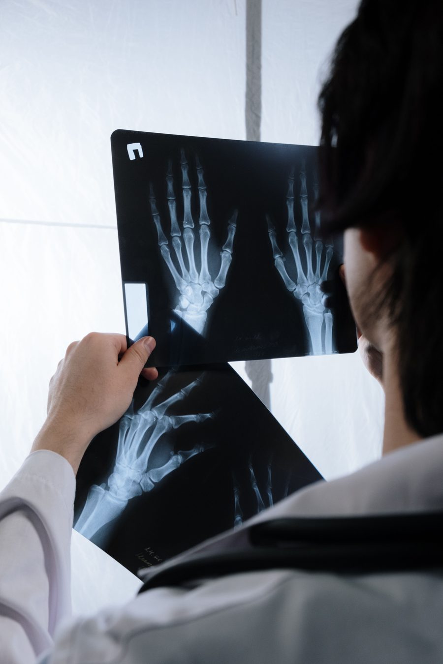 A hand surgeon holding up X-ray films of two hands against a light box